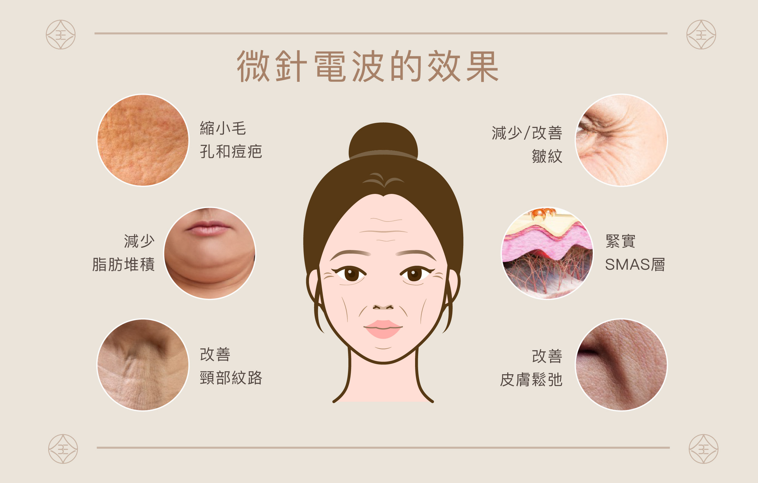 微針電波全攻略 !! 優點特色、作用原理、常見問題一次掌握 ! - 全臻妍美學診所∣台中北屯區北區醫美醫師診所推薦、台中北屯區玻尿酸雷射醫美 ...